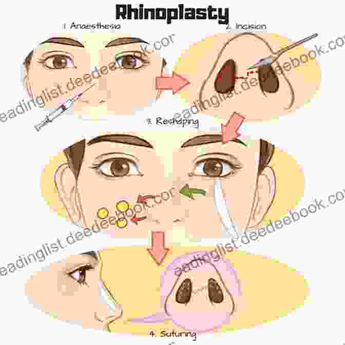 Diagram Of The Italian Method Of Rhinoplasty Rhinoplasty And The Nose In Early Modern British Medicine And Culture (Social Histories Of Medicine 25)