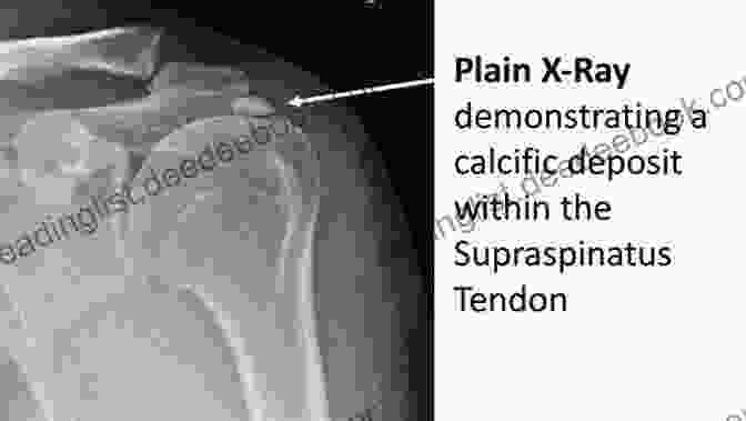 X Ray Of The Right Shoulder Showing A Small Calcific Deposit In The Supraspinatus Tendon 100 Cases In Orthopaedics And Rheumatology